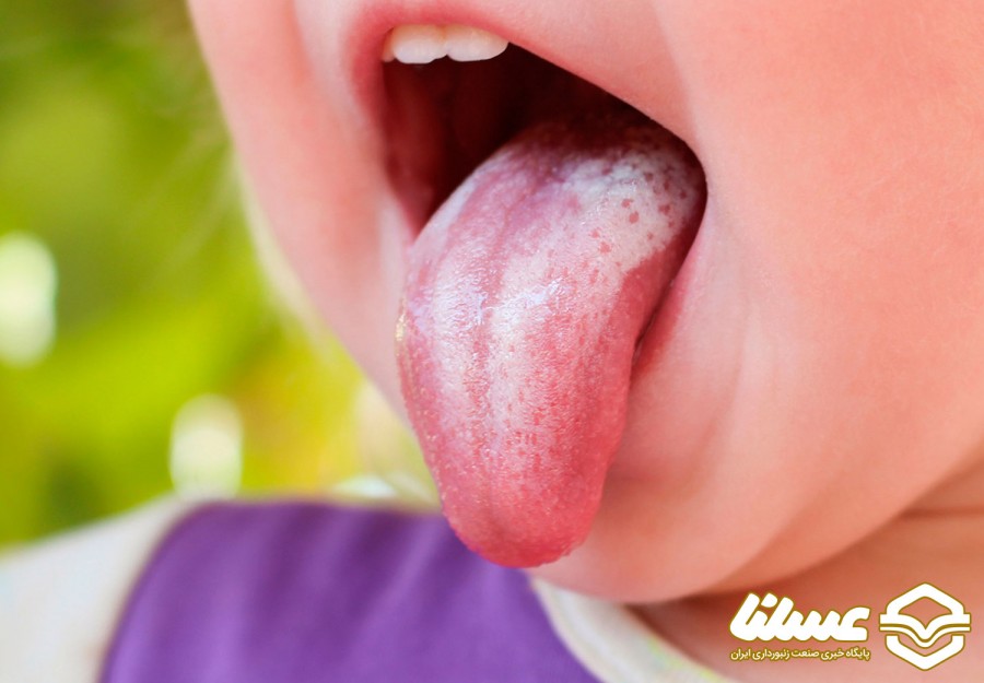 چقدر در مورد درمان برفک دهان با بره موم اطلاعات دارید؟