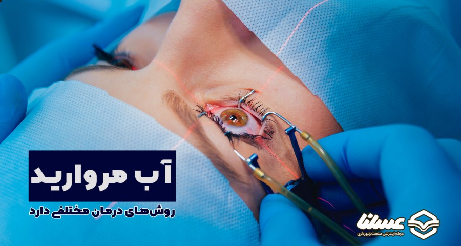 درمان آب مروارید چشم