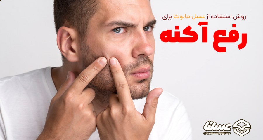 رفع آکنه با عسل مانوکا