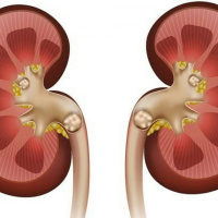 همه چیز در مورد سنگ کلیه / توصیه ها و  نسخه های خانگی و گیاهی برای درمان سنگ کلیه