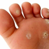 میخچه چیست؟ / عوامل ایجاد میخچه و درمان های خانگی ساده بدون نیاز به جراحی