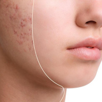 خارش و سوزش بعد از اصلاح /  چه کار کنیم تا بعد از اصلاح به پوستمان جوش نزند؟