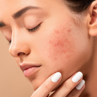 چند ترکیب خانگی ساده برای رفع سریع جای جوش و لک صورت با عسل