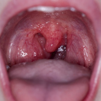 تورم و التهاب زبان کوچک / درمان های خانگی برای رفع التهاب زبان کوچک در درهان