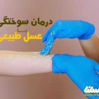 چطور از عسل برای درمان سوختگی سطحی استفاده کنیم؟