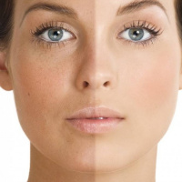 تیرگی پوست صورت / علل و راهکارهای درمانی