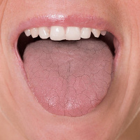 راهکارهای ساده برای خلاص شدن از خشکی دهان