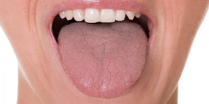 راهکارهای ساده برای خلاص شدن از خشکی دهان